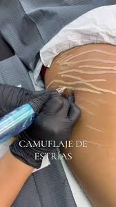 Restauracion- Camuflaje de estrias- cnsulte costo x zonas