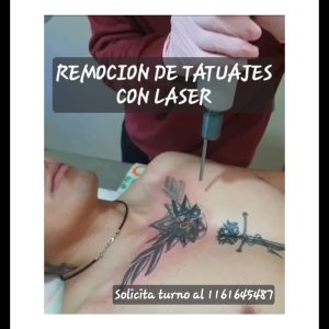 Eliminacion de tatuajes consulta precios promocionales segun tamano, equipo de ultima generacion!!!!